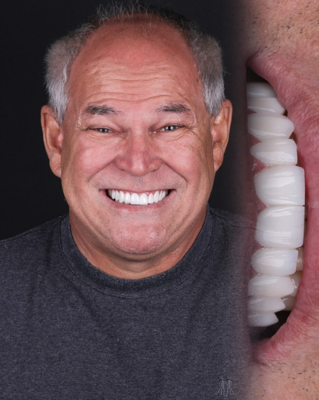 Paciente sorrindo após lentes de contato dental, com detalhe da arcada